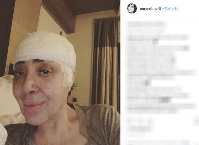 Modacı Nur Yerlitaş, yeniden ameliyat olduğunu herkesten gizledi 7